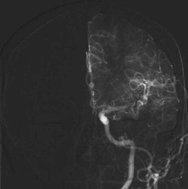 Příznivá pooperační angiografie bez plnění vaku.