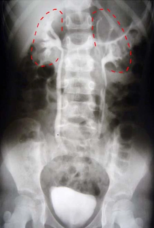 <i>Intravenózna urografia</i>
Fig. 1. <i>Intravenous urography</i>