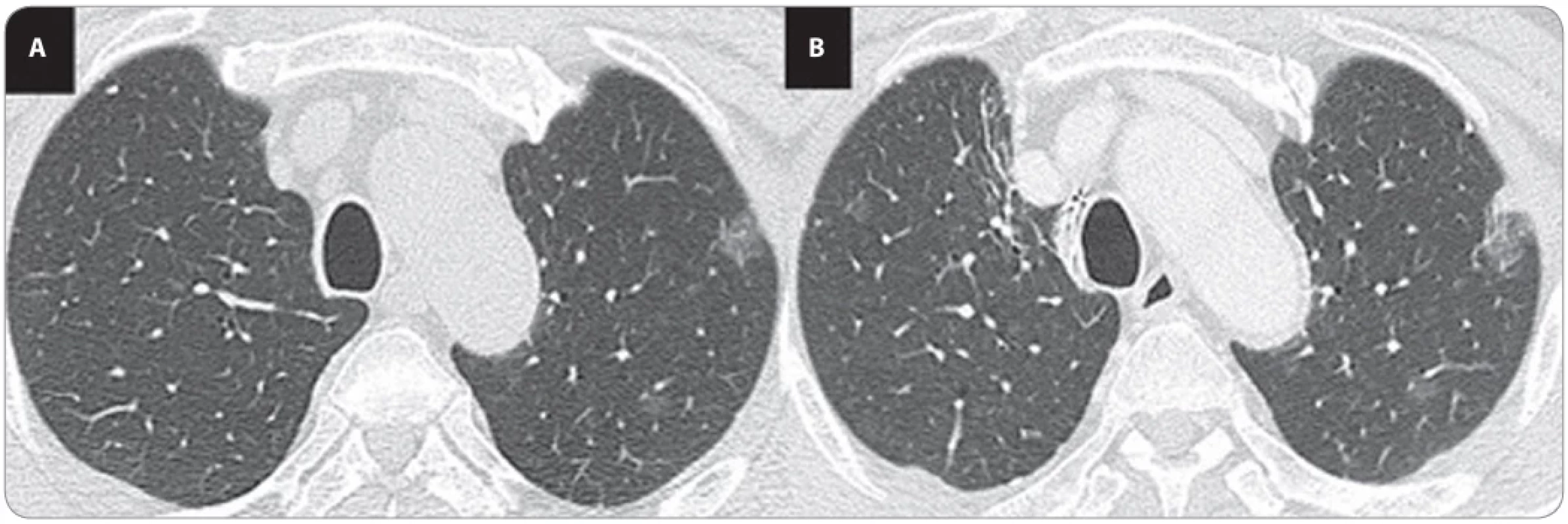 A ground-glass opacity (GGO) nodule in the left upper lobe that was present at the initial consultation (A) had grown in size  on a CT scan performed 1 year and 4 months after the right lung resection (B).