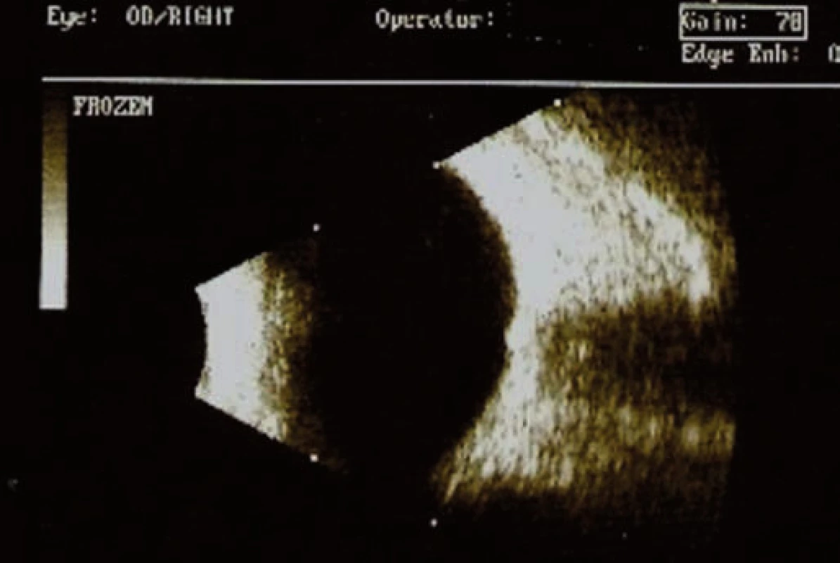 B-scan ultrazvukové vyšetrenie pravé oko (pacient č. 1).
Na úrovni TZN viditeľné hyperechogénne útvary – drúzy.