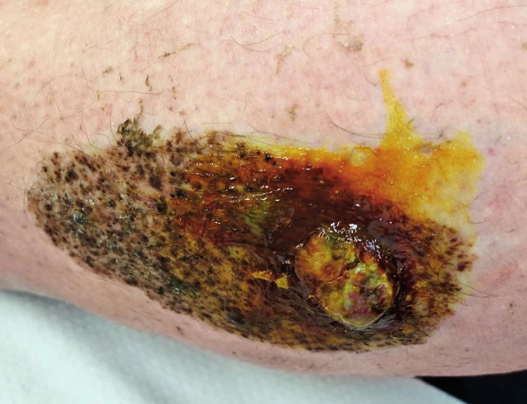 Nodular melanoma developed in a congenital nevus on the calf in a 51-year-old patient, Breslow 12 mm, Clark V