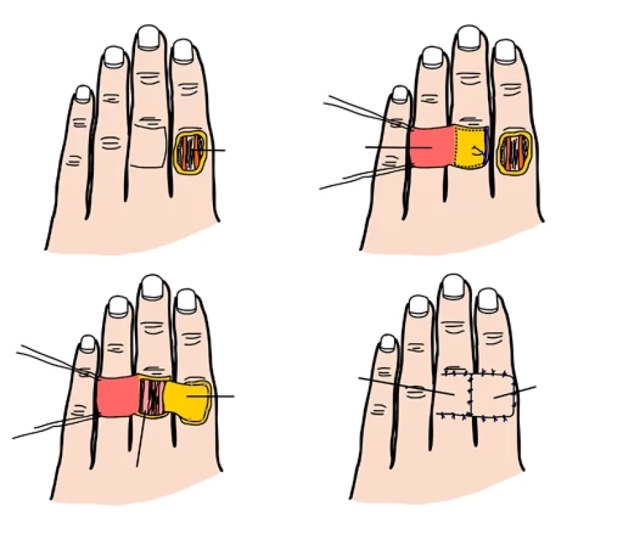Reverzní cross finger flap.