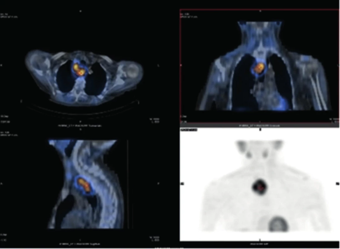 SPECT/CT − kazuistika 2
Fig. 2: SPECT/CT − case report 2