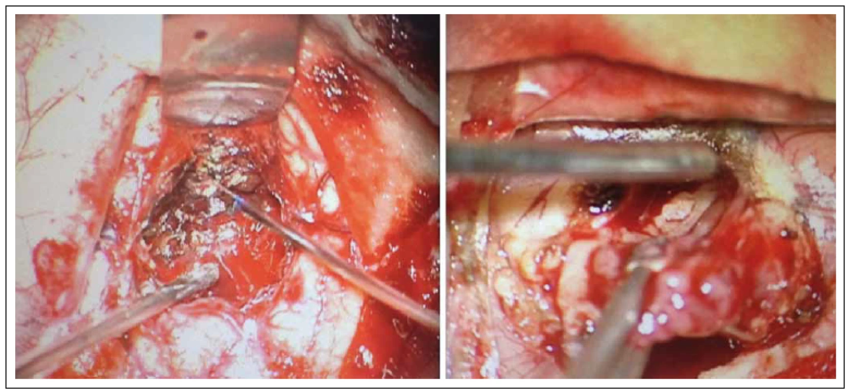 Perioperační pohled na resekci.
Fig. 1. Perioperative view on resection.