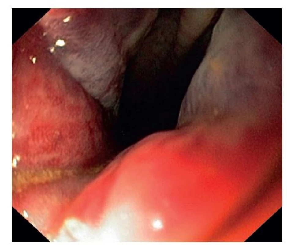 Obr. 3: Sigmoideoskopie s prokrvácenými hemoroidy a ascaridou
Fig. 3: Sigmoideoscopy with haemmatose haemmoroids and pinworm