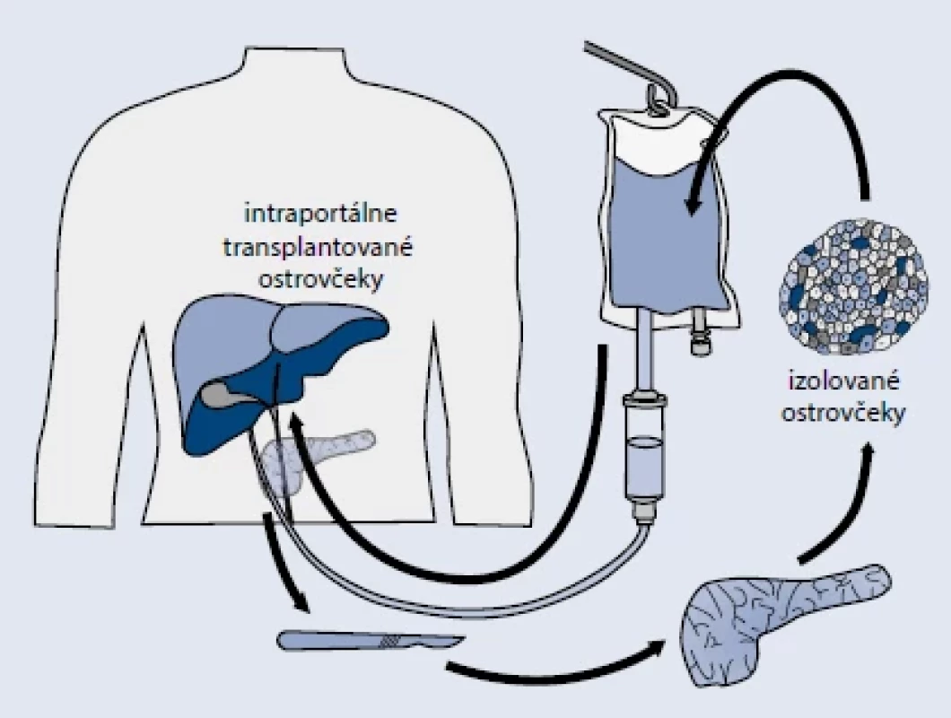Totálna pankreatektómia s autotransplantáciou Langerhansových ostrovčekov. Upravené podľa [1]