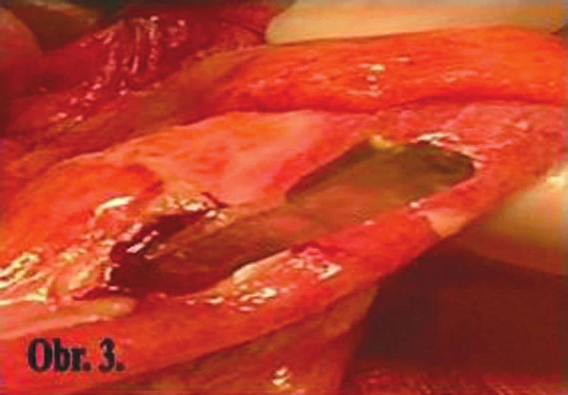 Perforačný otvor na sigme
Fig. 3: Perforation hole in the sigmoid colon