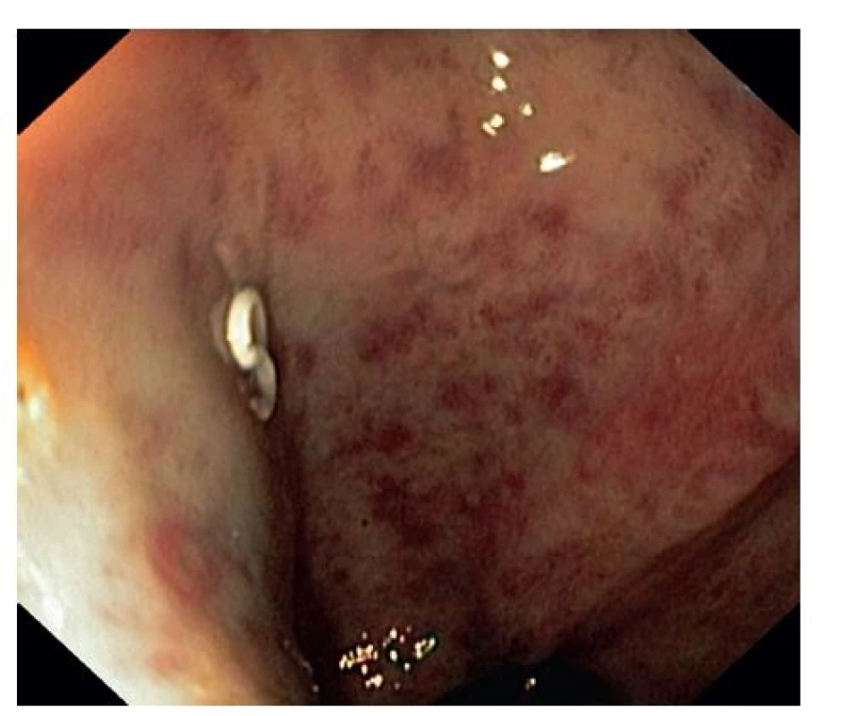 Obr. 4: Sigmoideoskopie s prokrvácenými hemoroidy a ascaridou
Fig. 4: Sigmoideoscopy with haemmatose haemmoroids and pinworm