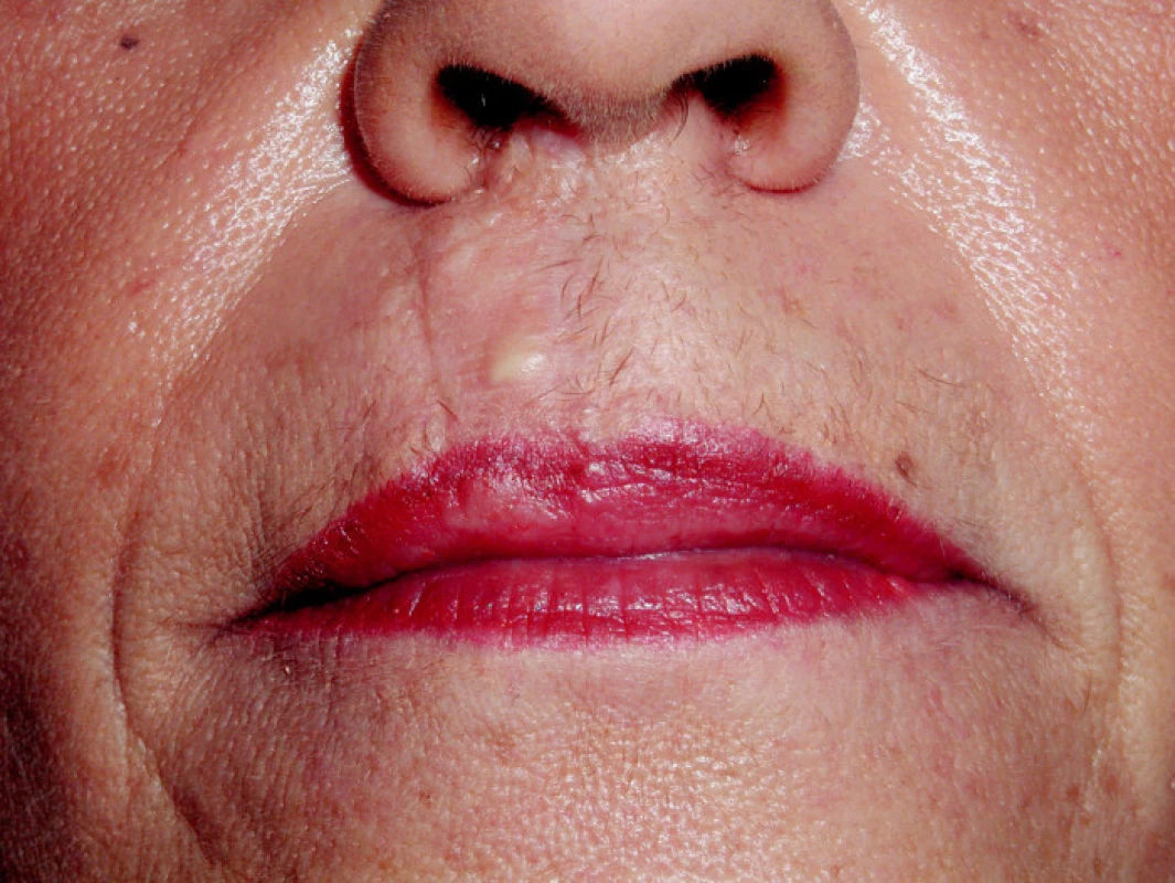 Stav před a po korekci primárně provedené transplantace ztrátového poranění horního rtu
Pic. 6. Correction of a primary transplantation of the upper lip defect injury- the pre- and postoperative conditi