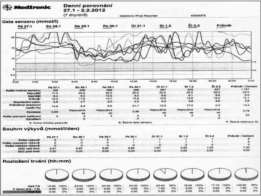 Průběh glykemií při monitorování pomocí kontinuálního senzoru u chronicky dekompenzovaného diabetika 1. typu.
