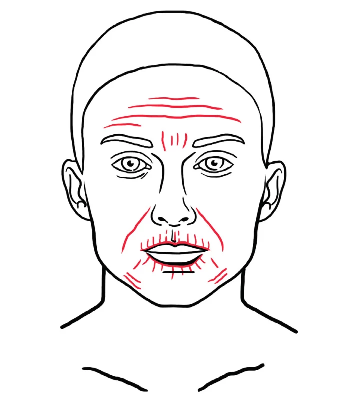 Red dotted areas represent examples of areas typically treated with nanofat for regenerative purposes