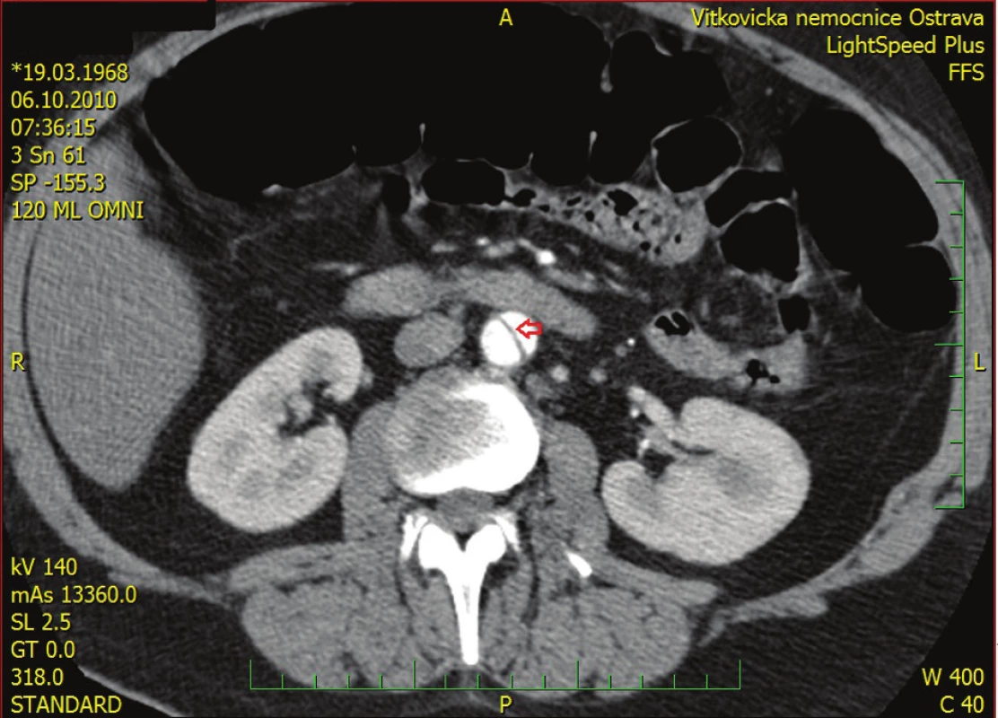 CT sken s obrazem dvojitého lumen aorty Červená šipka ukazuje odchlípnutý endotel.
Fig. 3: CT scan showing double-barrel dissected abdominal aorta Red arrow indicates the intimal flap