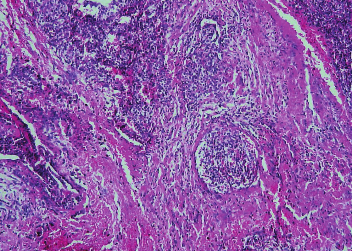 Parathyroid carcinoma. The presence of vascular invasion in parathyroid carcinoma (hematoxylin and eosin, magnifications x 200).