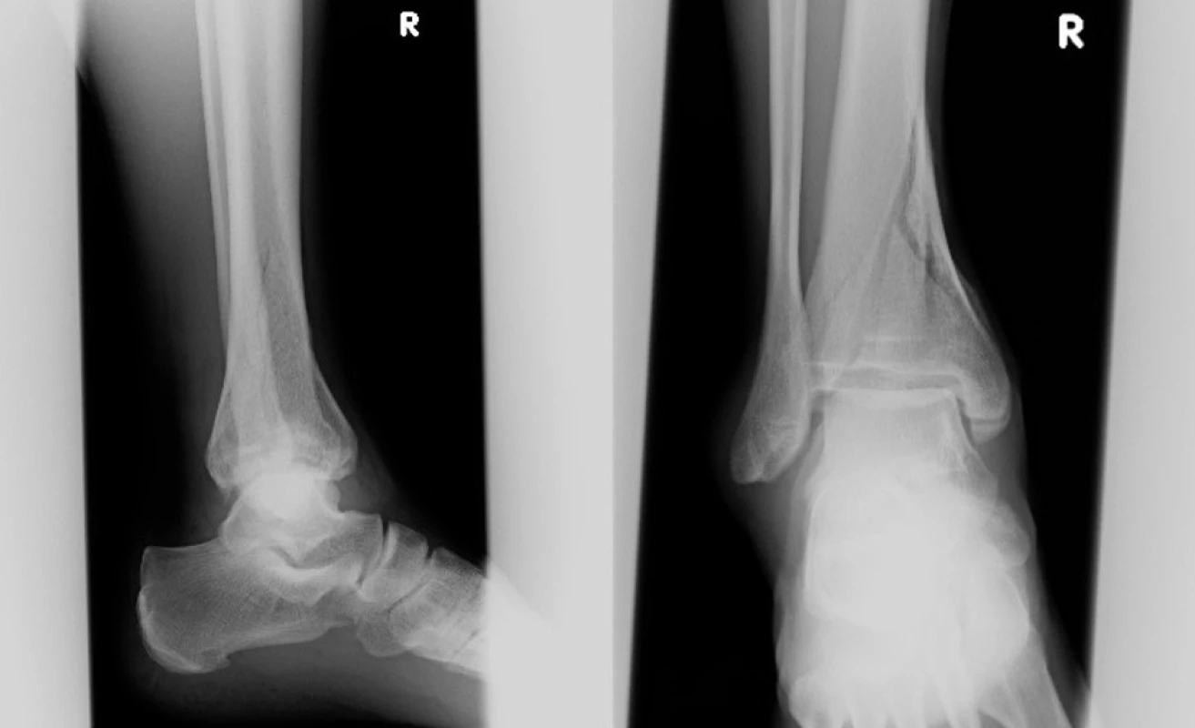 Vstupní rtg recentně po úrazu
Fig. 2: Initial X-ray shortly after injury