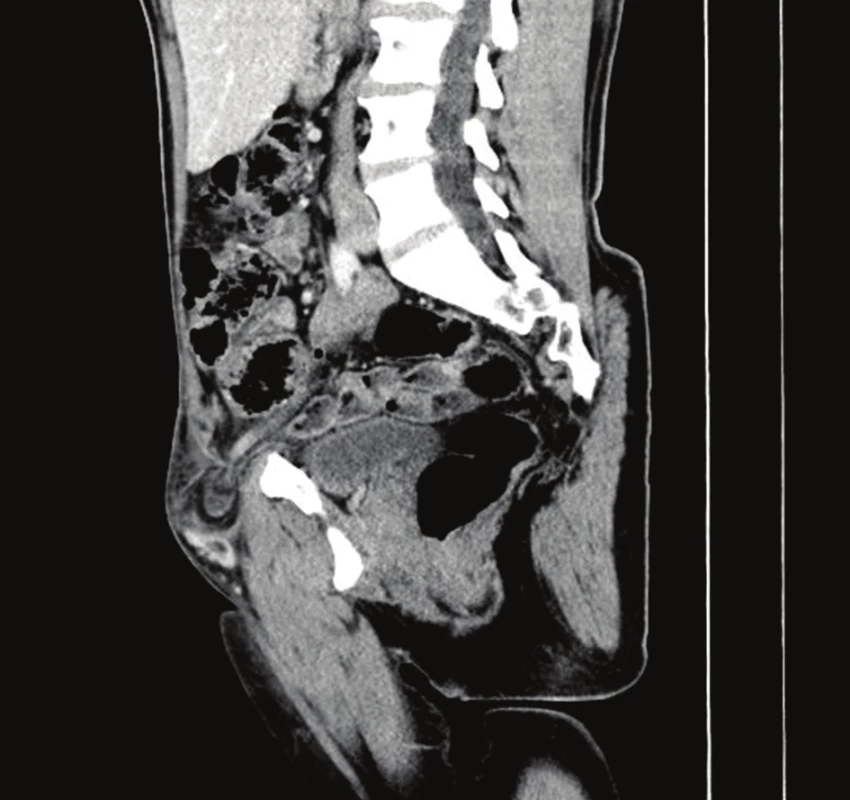 CT nález – femorální hernie s inkarcerovaným apendixem
Fig. 1: CT findings – incarcerated femoral hernia with appendix