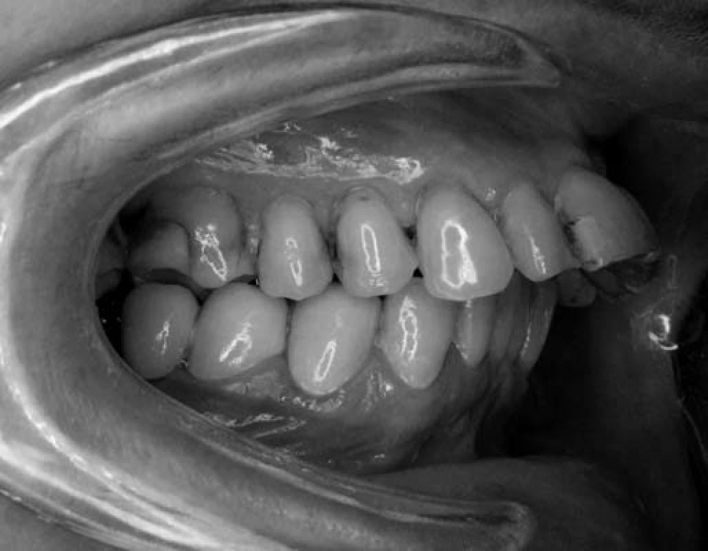 Výrazné vyklopenie – protrúzia rezákov u pacientky č. 1.
Fig. 1. Severe upper incisors protrusion in patient No. 1.