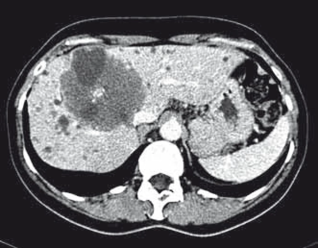 CT s kontrastom – axiálne zobrazenie. Prítomnosť rozsiahlej echinokokovej cysty v pečeni.
Fig. 1. CT scan with contrast. Axial image. Presence of extensive hydatid cyst in the liver.