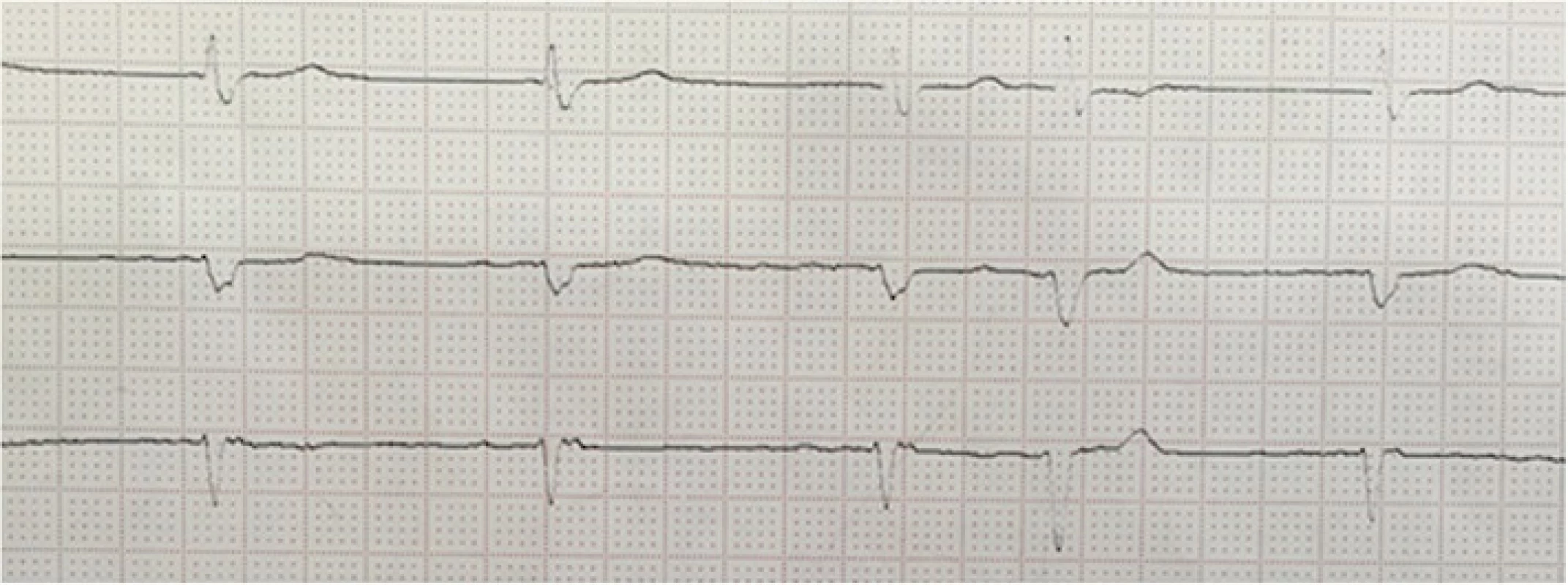 ECG on admission showing slow atrial fibrillation