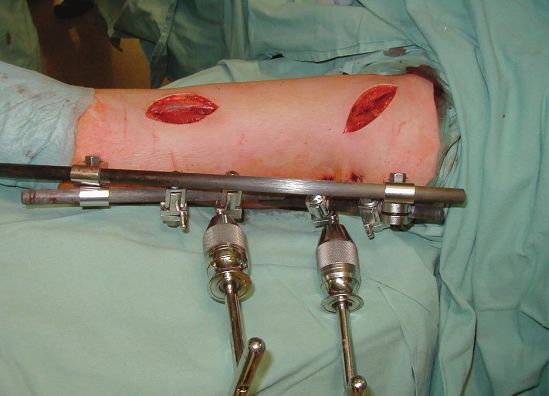 Užití zevního fixátoru k udržení repozice před podvlečením dlahy
Pic. 2. Use of external fixation for reposition