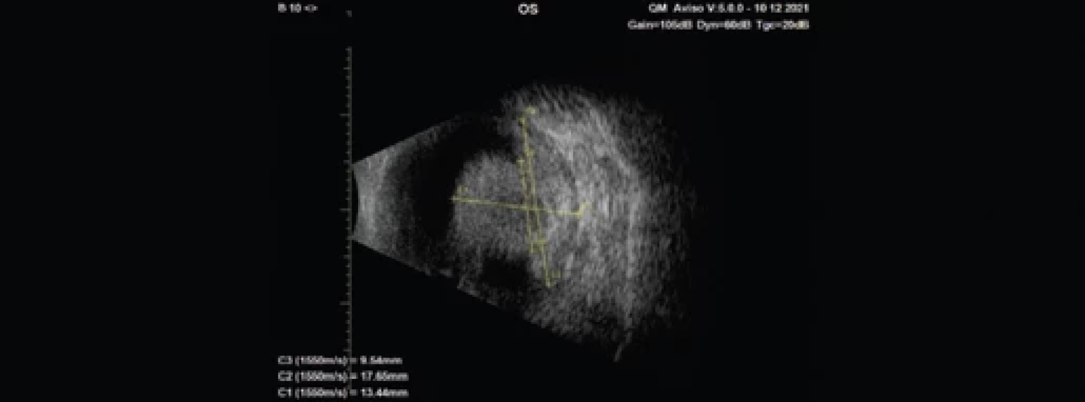 Ultrazvukové vyšetření očního bulbu, vývoj onemocnění v čase. A) nález 29. 1. 2021; B) nález 23. 4. 2021; C) nález 10. 12. 2021.