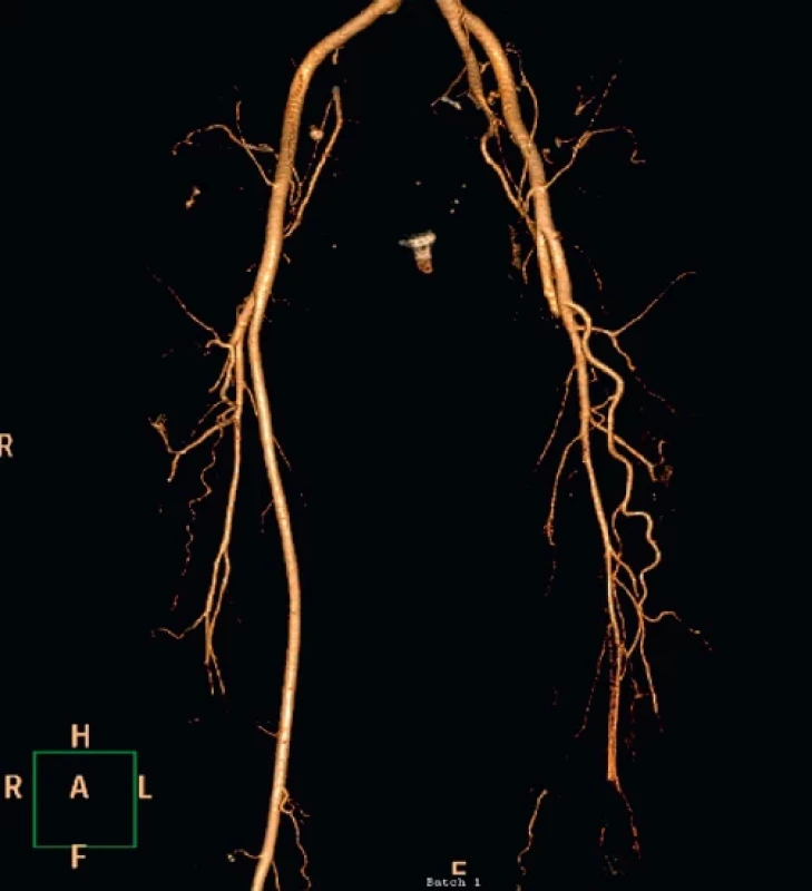 CT – reconstruction picture – missing of the AFS and AP on the left limb after their stripping.
