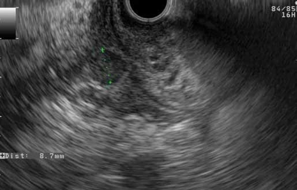 EUS finding of GP: a hypoechoic area between the duodenal wall and pancreatic parenchyma with a cyst in the duodenal wall (patient 2).
Obr. 7. EUS obraz GP: hypoechogénna oblasť medzi stenou duodéna a parenchýmom pankreasu s cystou v stene duodéna (pacient č. 2).