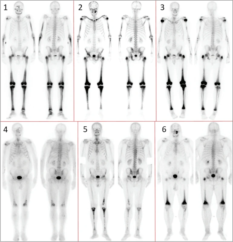 Scintigrafie skeletu – přehled pacientů 1–6, číslování odpovídá tabulce 1.