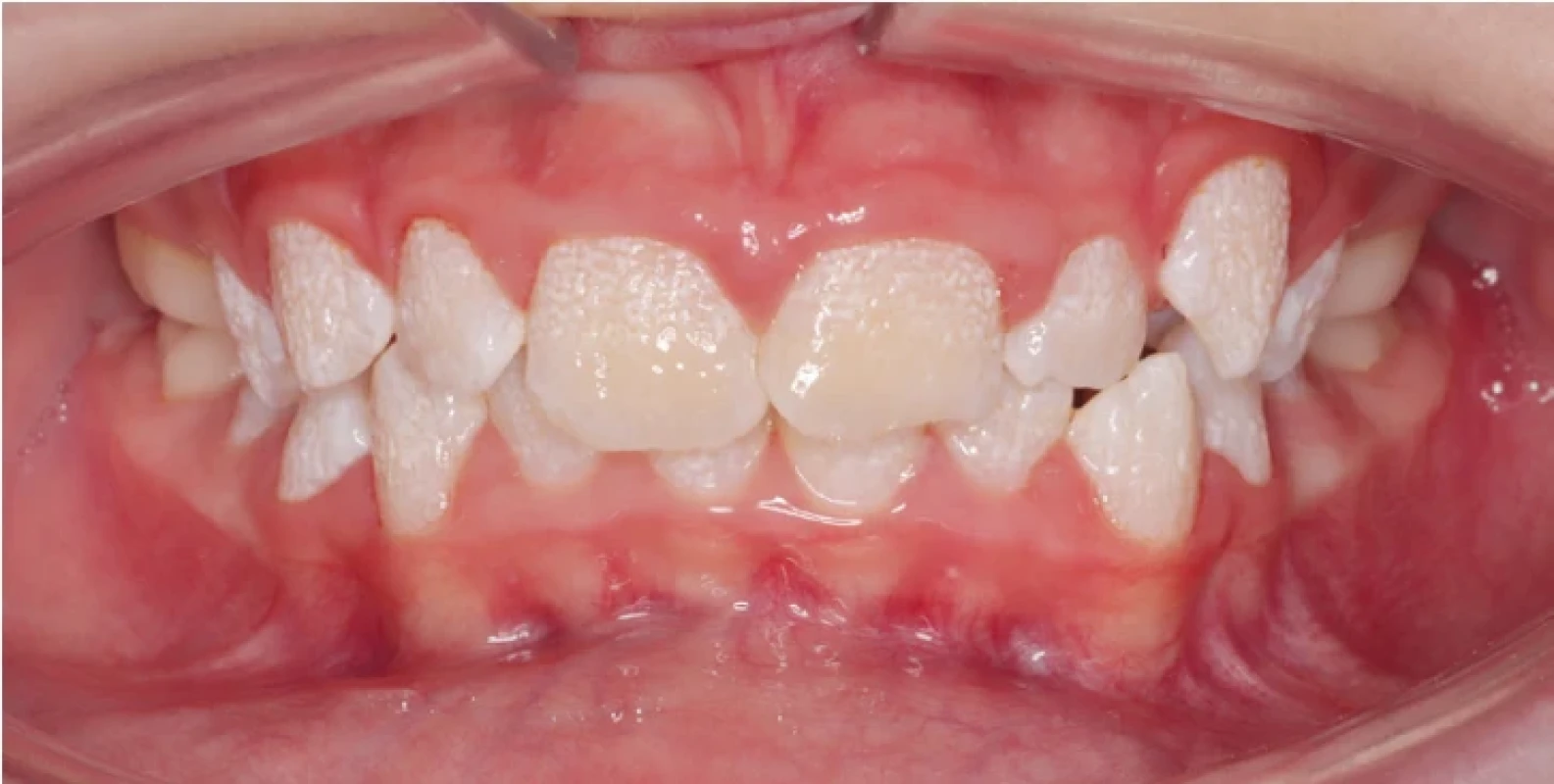 Intraorální fotografie pacienta s hypoplastickou formou amelogenesis imperfecta. Na fotografii můžeme pozorovat generalizovaný výskyt jamek, který je podložen nerovnoměrným vývojem skloviny. Archiv obrazové dokumentace Stomatologické kliniky FNKV, 3. LF UK a Rozštěpového centra FNKV Praha. Fig. 1 Intraoral image of a patient with the hypoplastic form of amelogenesis imperfecta. The image shows a generalized distribution of pits resulting from uneven enamel formation. Archive of Department of Stomatology, 3rd Faculty of Medicine, Charles University, and University Hospital Kralovske Vinohrady, and Cleft Centre Prague, University Hospital Kralovske Vinohrady