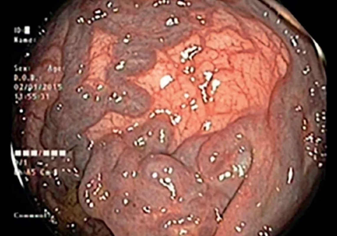  Anorektální varixy [18].  Anorectal varices [18].