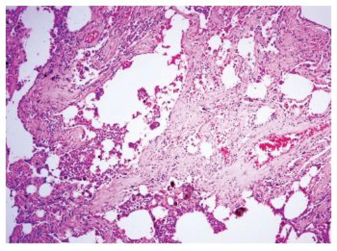Hypocelulární septální fibróza s různým stupněm rozšíření alveolárních sept depozity kolagenu u SRIF. Fibrotizace je přítomná nejen subpleurálně, ale i hlouběji v parenchymu v centrolobulárních oblastech. V distendovaných alveolárních prostorech jsou četné kuřácké marofágy. Standardní barvení H&amp;E - původní zvětšení 100x.