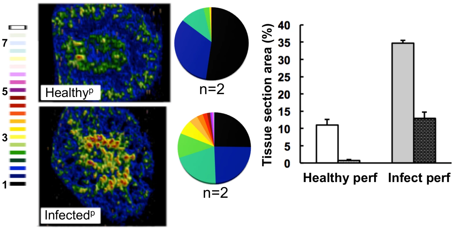 The medullary iron accumulated in advanced candidiasis is associated with renal tissue.