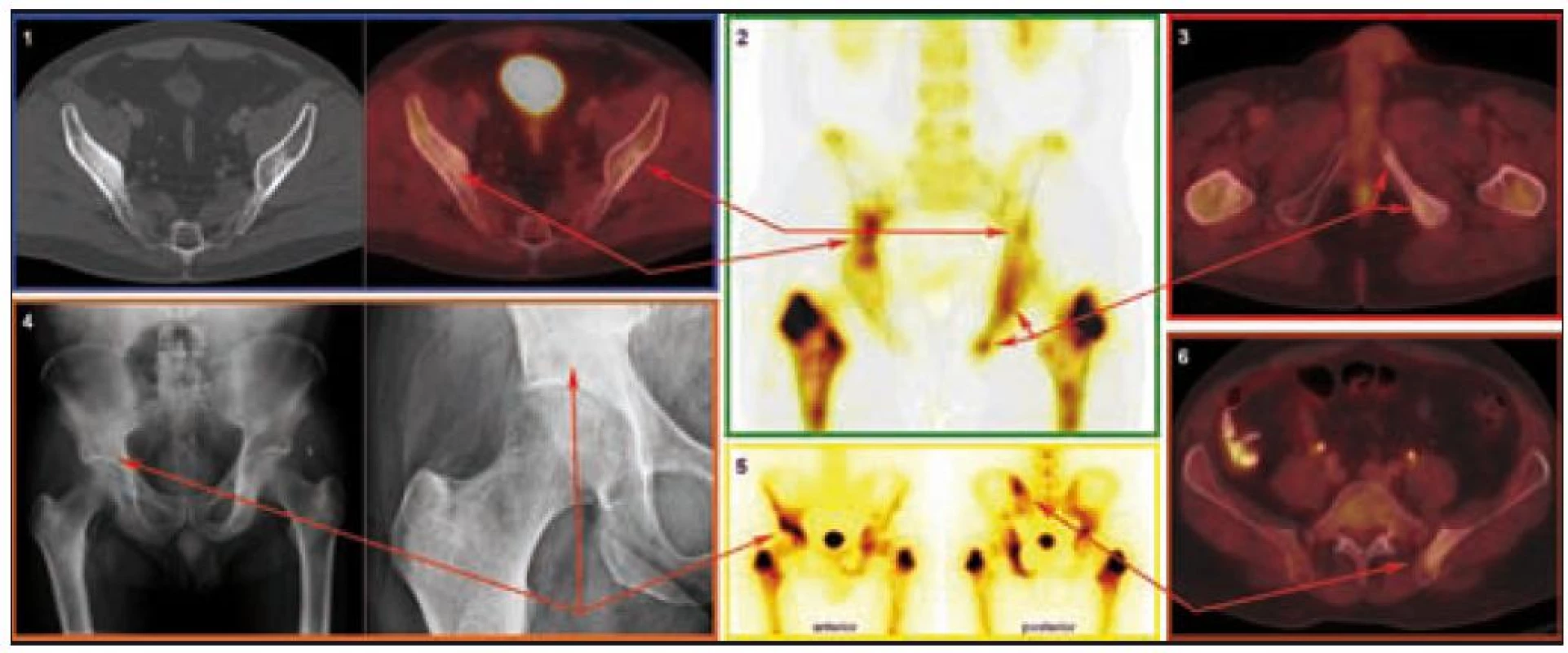 Charakteristická patologie v oblasti pánevního pletence z pohledu různých zobrazovacích modalit.

CT a PET/CT (1): Nepravidelná struktura s nápadnými sklerotickými okrsky, místy v terénu prořídlé struktury v oblasti obou lopat kostí kyčelních. PET komponenta zachycuje difuzně zvýšenou aktivitu FDG v místech strukturálních změn popisovaných na CT.

SPECT (2) a scintigrafie skeletu (5): Zvýšená aktivita radiofarmaka v oblasti kosti sedací a stydké vlevo, v oblasti kosti kyčelní vpravo a dále v oblasti levého sakroiliakálního skloubení.

PET/CT (3): Nepravidelná struktura s nápadnými sklerotickými okrsky, místy v terénu prořídlé struktury v oblasti levé kosti stydké a levé kosti sedací. PET komponenta zachycuje difuzně zvýšenou aktivitu FDG v místech strukturálních změn popisovaných na CT.

RTG (4): Mírné zahuštění struktury spongiózy v okolí pravého acetabula, krčku lopaty kosti kyčelní.

PET/CT (6): Nepravidelná struktura s nápadnými sklerotickými okrsky, místy v terénu prořídlé struktury vlevo v lopatě kosti kyčelní v blízkosti sakroiliakálního skloubení. PET komponenta zachycuje difuzně zvýšenou aktivitu FDG v místech strukturálních změn popisovaných na CT.