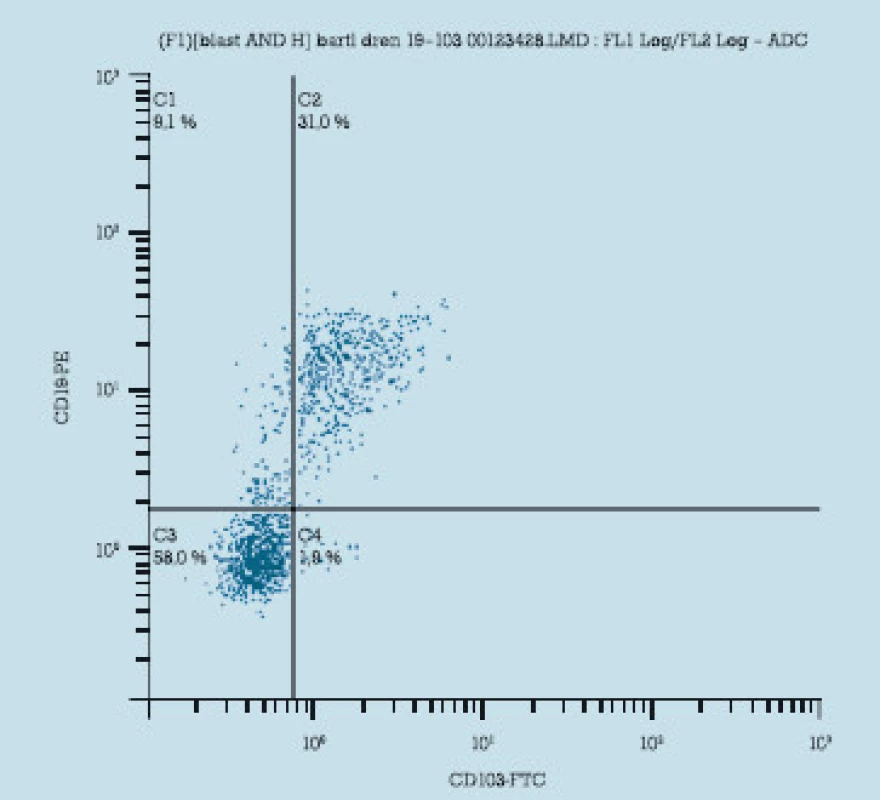 Imunofenotypové znaky CD 19+ a CD 103+ u HCL (průtoková cytometrie).