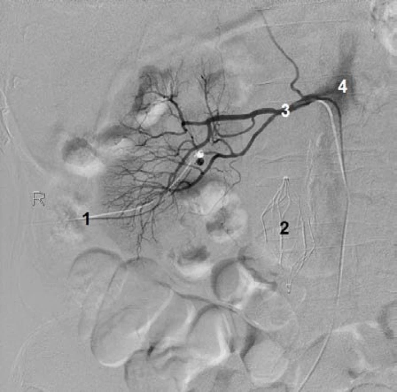 Angiografie pravé ledviny. 1) Nefrostomie, 2) kavální filtr v dolní duté žíle, 3) pravá renální arterie, 4) břišní aorta
Fig. 1 Angiography of right kidney. 1) Nephrostomy, 2) filter of inferior vena cava, 3) right renal artery, 4) abdominal aorta
