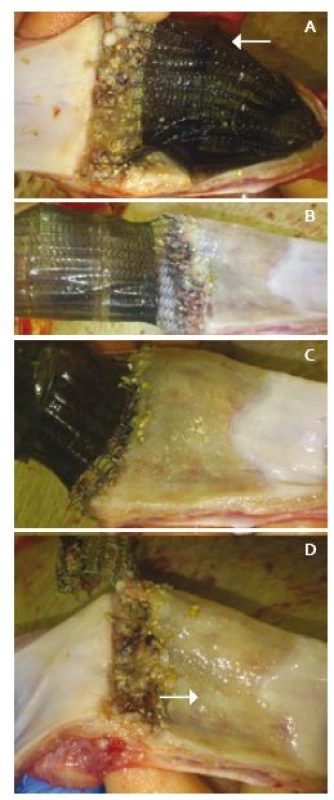 Pitevní nálezy distálního jícnu po týdnu: A. Stent přichycen patologicky ke stěně, distálně pokryt Xe - Dermou<sup>®</sup> (značeno šipkou). B, C. Stěna jícnu po postupném odstranění stentu, který pevně lne k nechráněnému pásu se zánětlivou reakcí. D. Patrné dvě kvality zhojení resekční plochy, s biomateriálem (značeno šipkou) a bez něj.
Fig. 1. Autopsy findings from distal oesophagus after one week: A. The stent is pathologically attached to the wall, distally still covered with black Derma<sup>®</sup> (arrow). B, C. Oesophagus wall after removal of the stent, which adheres firmly to the unprotected belt with inflammatory reactions. D. Two qualities of healing of the resection surface, with (arrow) and without biomaterial.