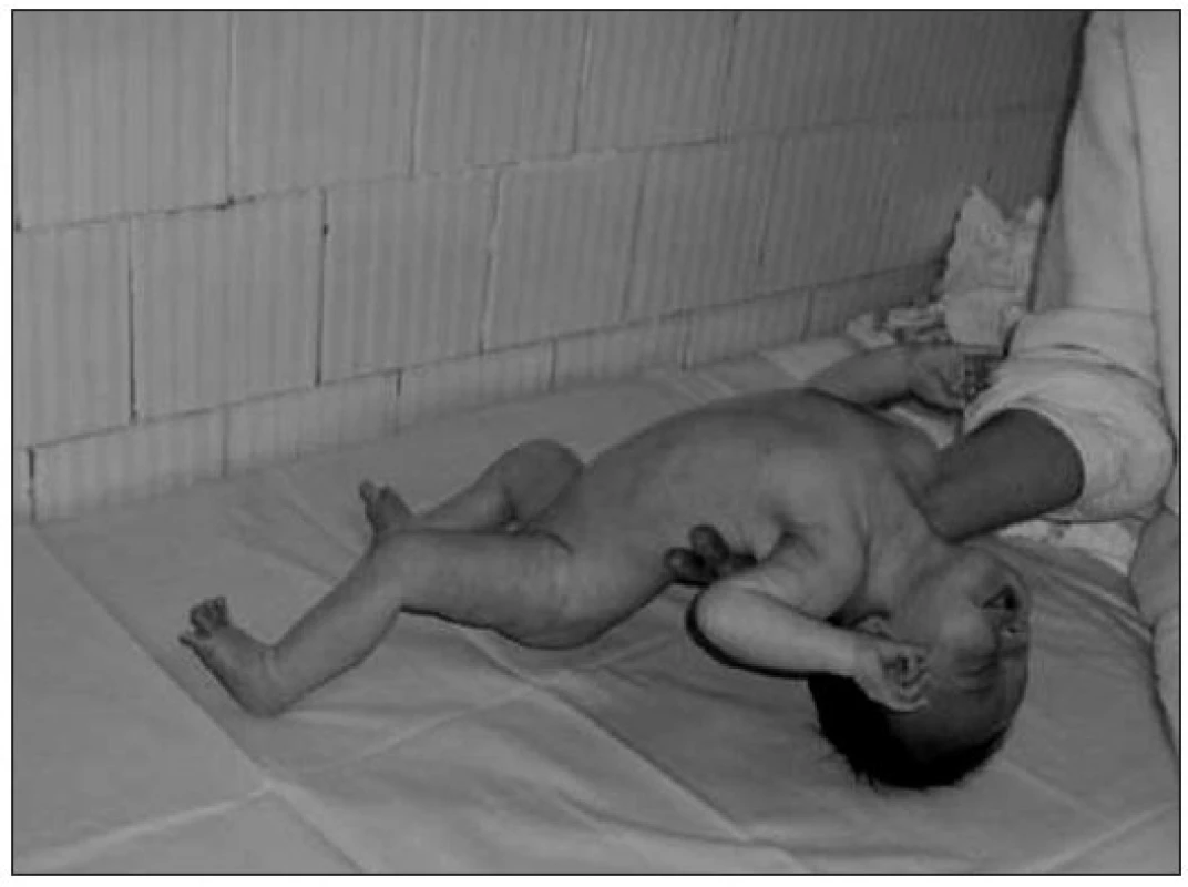 Kazuistika 2. Extrémna hypotónia u novorodenca ako dominantný príznak pre PWS.
Fig. 4. Case report 2. Extreme hypotonia in the newborn as a dominant symptom of PWS.