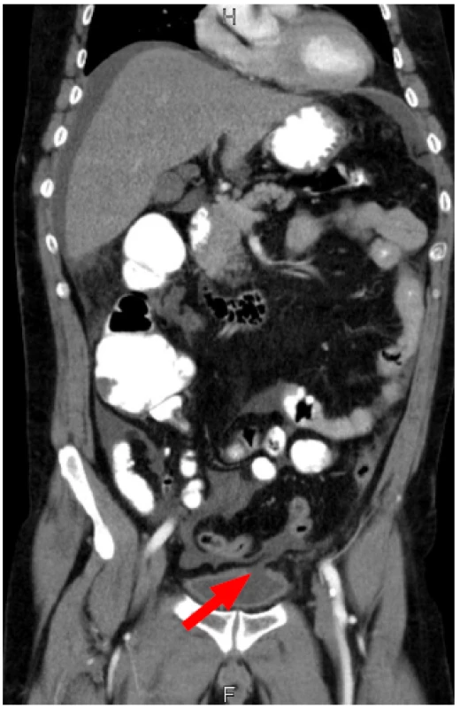 CT vyšetření: defekt stěny v oblasti vrcholu močového měchýře
Fig. 1 CT scan: defect of the bladder wall at the dome