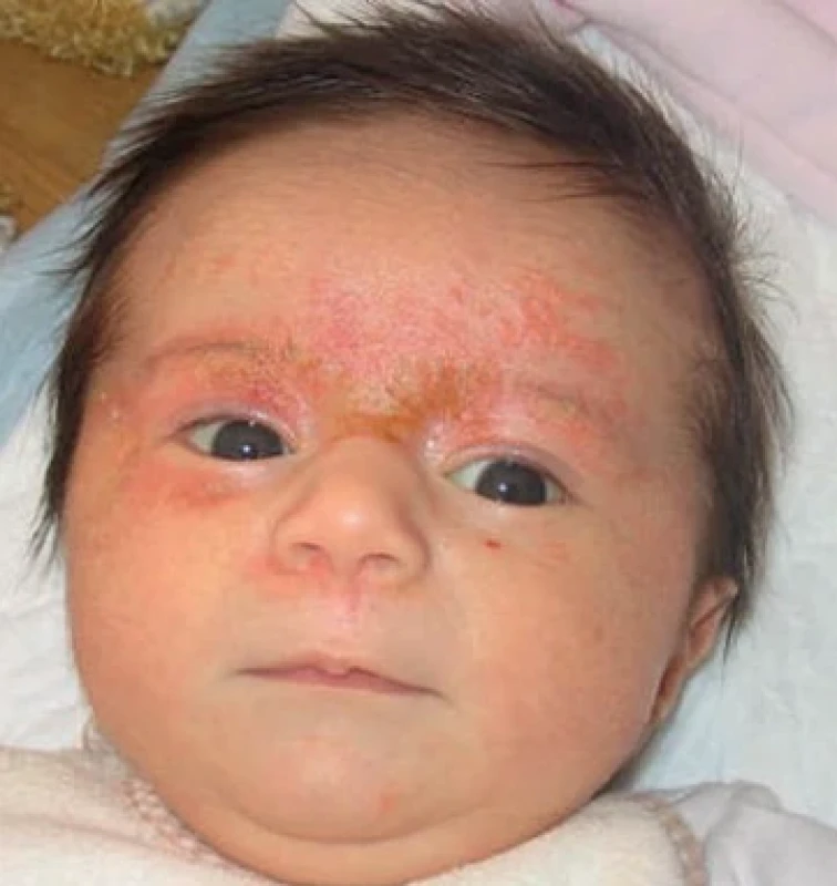 Seboroická dermatitida, děvče 3 týdny