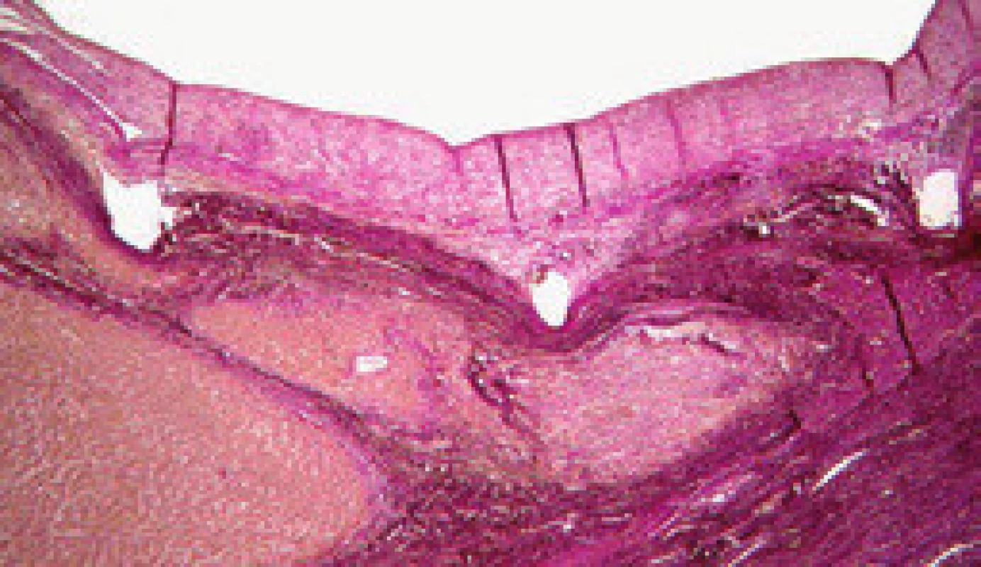 Pseudointima (21 měsíců po zavedení TIPS).
Fig. 3. Pseudointima (21 months after the introduction of TIPS).