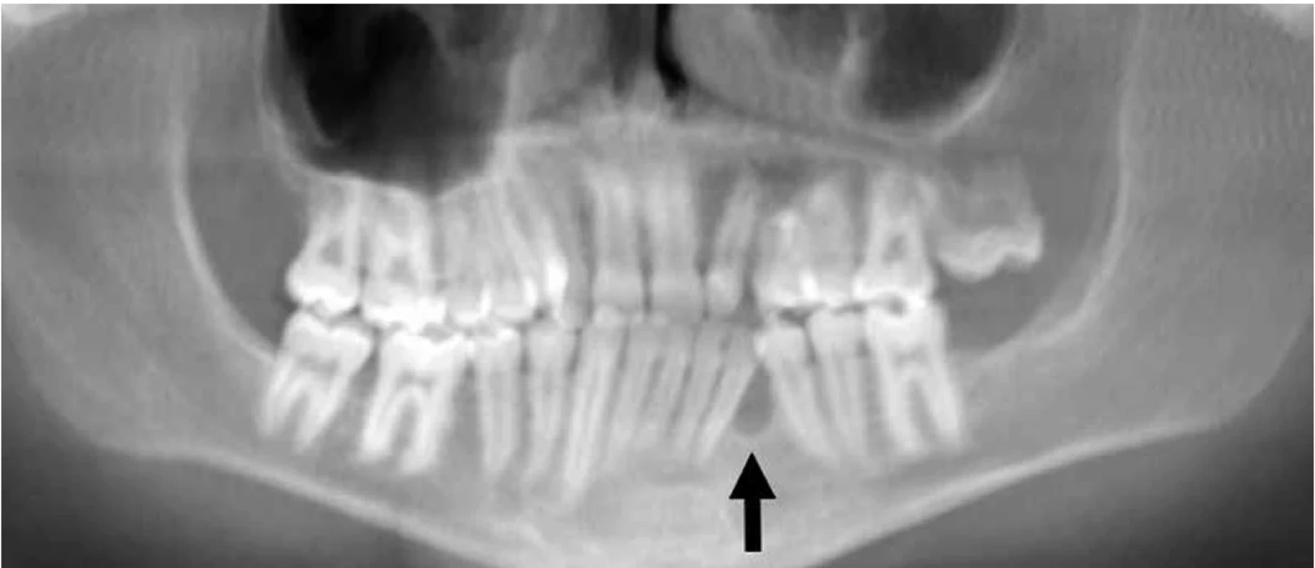 Rentgenový snímek čelistí pacienta s přítomností  odontogenní cysty mandibuly (šipka)