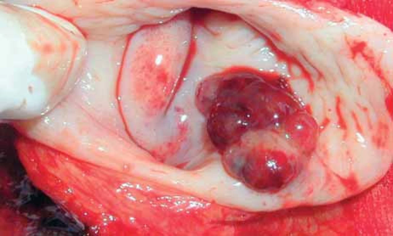 Clear-cell-karcinom pochvy.