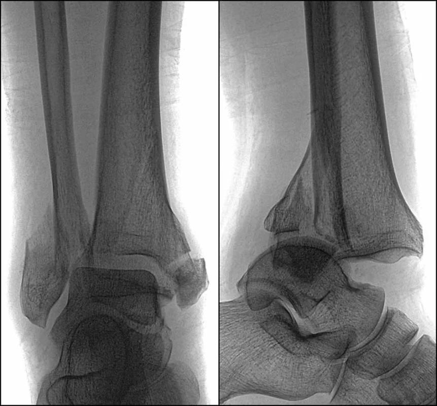 Nezreponovaná typická Bosworthova zlomenina </br> A typical displaced Bosworth fracture