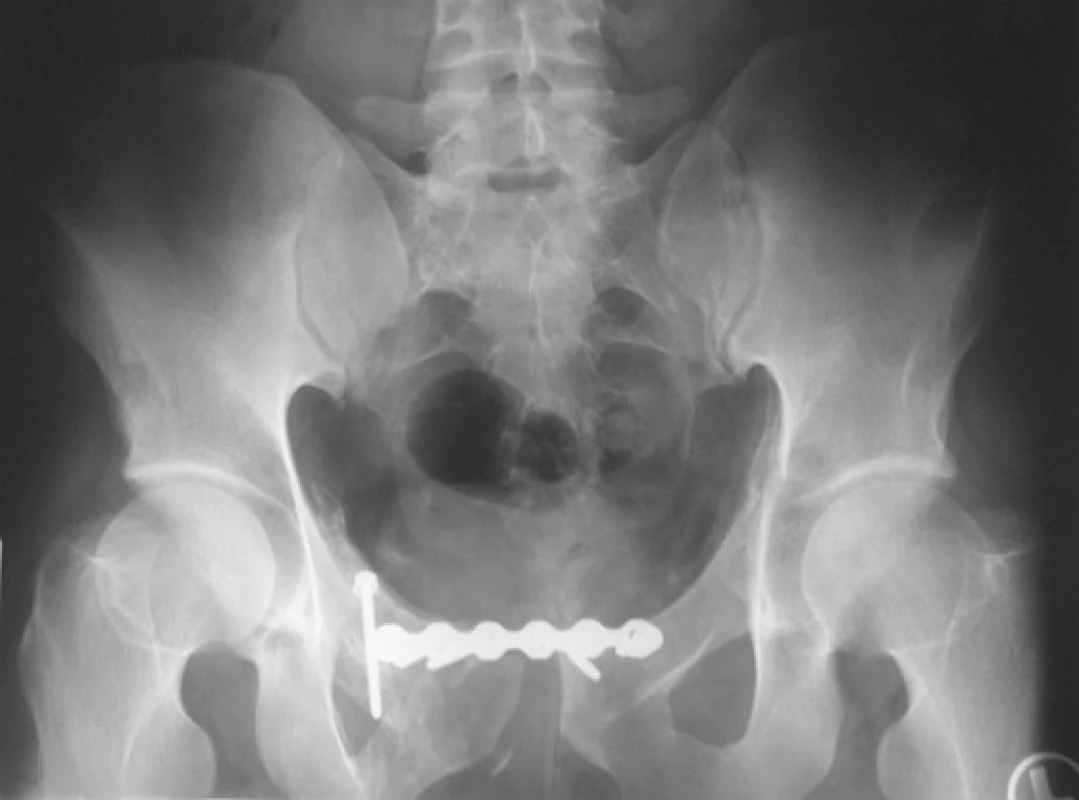 Stav s odstupem 9 měsíců po sutuře měchýře a osteosyntéze předního segmentu úhlově stabilní dlahou a jedním šroubem v oblasti horního stydkého raménka s patrným zhojením všech zlomenin v příznivém postavení
