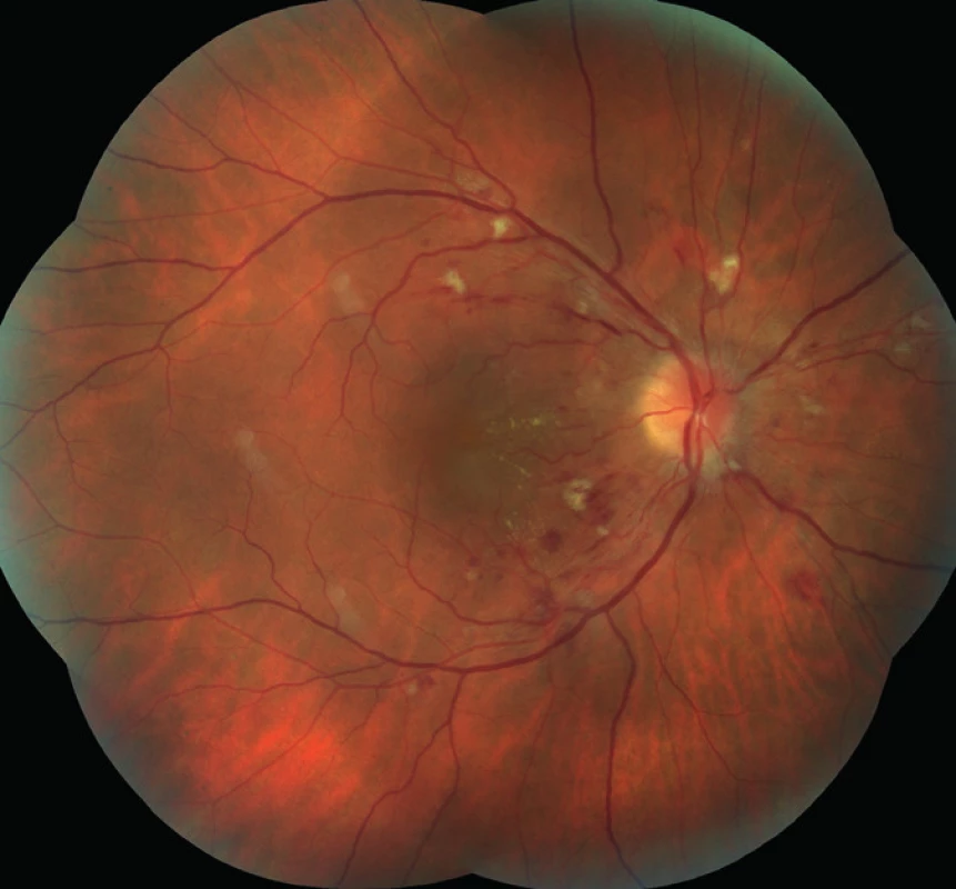 Pravé oko. Terč zrakového nervu neostrých hranic. Vatovitá ložiska a difúzní intraretinální hemorrhagie. V centrální krajině náznak hvězdicovité figury, edém makuly.