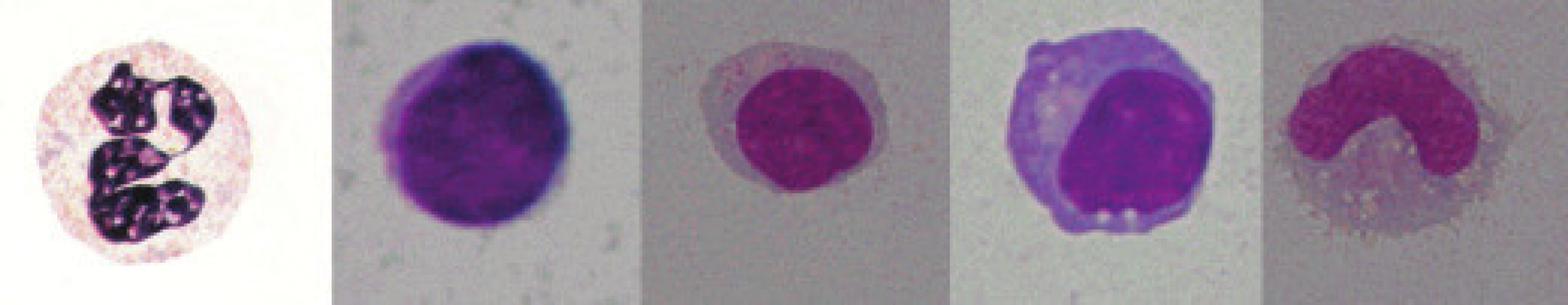 Formy leukocytů (1 segment, 2 a 3 lymfocyt, 4 plazmocyt a 5 monocyt).