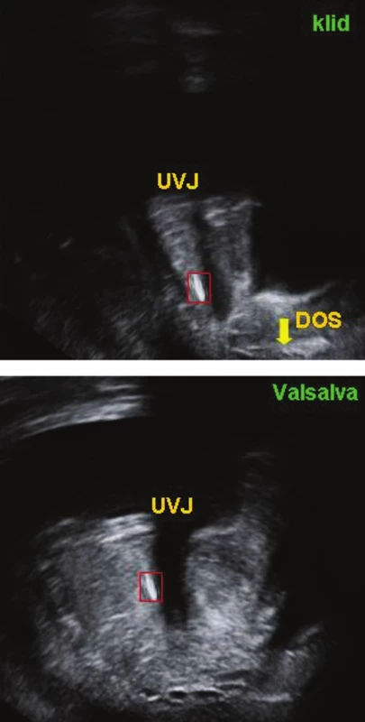 Introitální sonografie u pacientky ve 37. týdnu gravidity ukazuje normální pozici VVP (červený rámeček) v klidovém stavu i při Valsalvově manévru.<br>
UVJ – uretrovezikální junkce,<br>
DOS – dolní okraj symfýzy