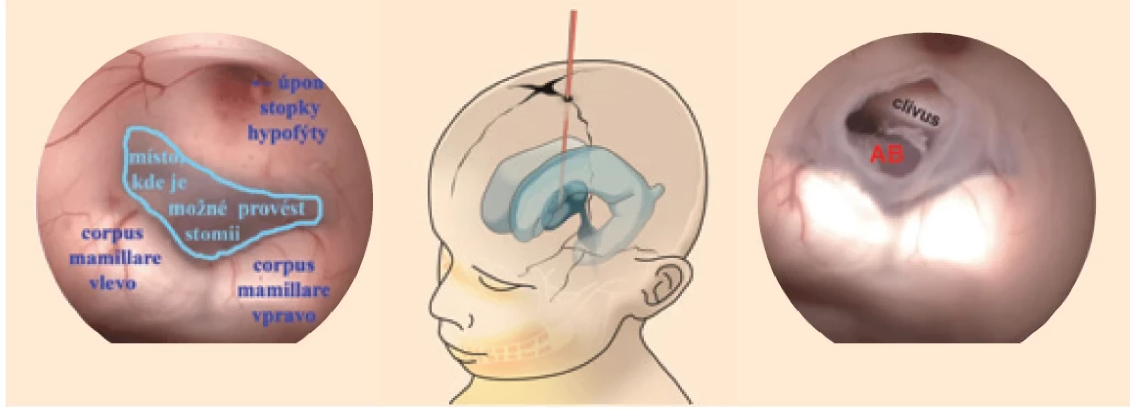 Endoskopická ventrikulostomie spodiny třetí komory.<br>Fig. 2. Endoscopic ventriculostomy of the fl oor of the third ventricle.