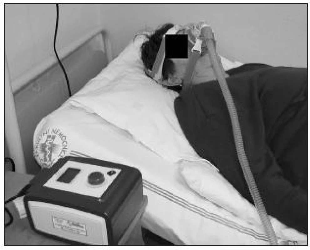 Léčba OSAS kontinuálním přetlakovým dýcháním pomocí přístroje CPAP (continuous positive airways pressure)