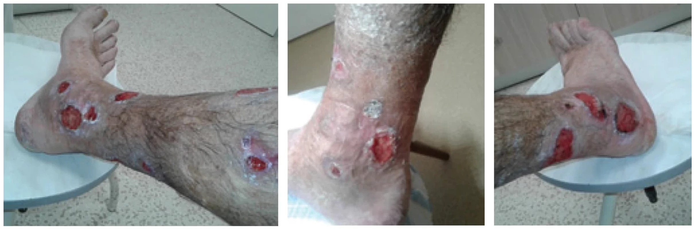 Defekty na bércích, které se po potlačení tvorby kryoglobuliny léčbou vyhojily. Zde zřejmě změny byly způsobené vaskulitidou při kryoglobulinémii.
