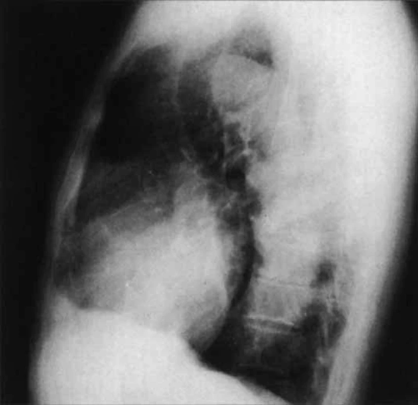 Revmatická aortální regurgitace: (a) Frontální RTG ukazuje zvětšení levé komory kompatibilní se stupněm regurgitace. Ascendentní aorta je nenápadná. (b) Boční projekce potvrzuje levokomorovou dilataci. Ascendentní aorta je normální.
